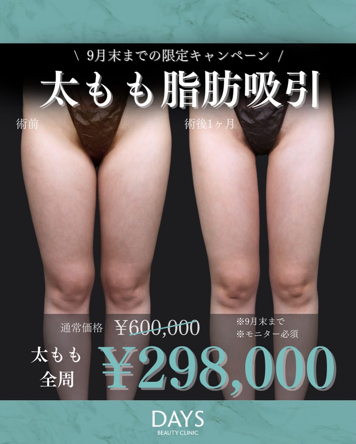 太もも脂肪吸引2509