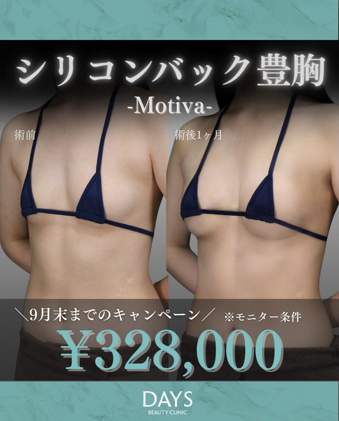 シリコンバック脂肪豊胸2508