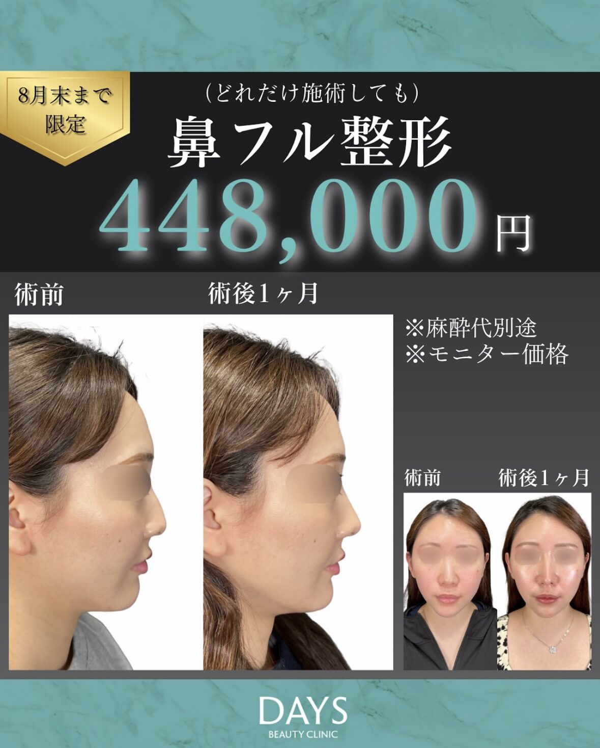 鼻の整形2508