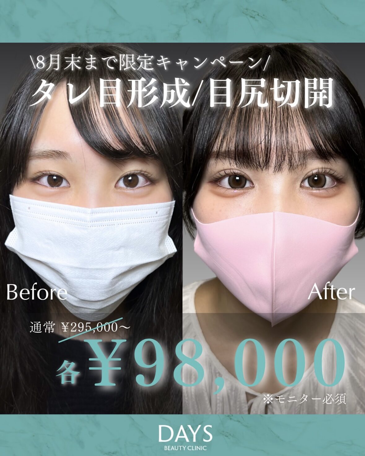 タレ目成形・目尻切開2508
