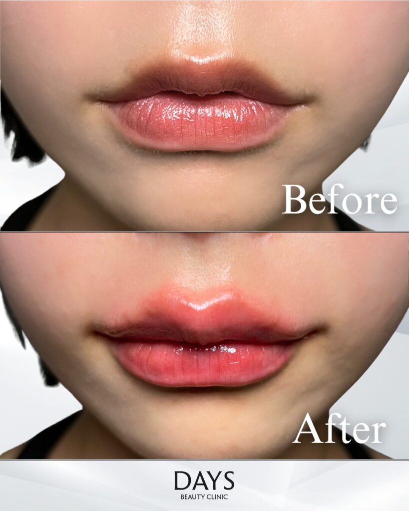 唇ヒアルロン酸　症例　20代女性