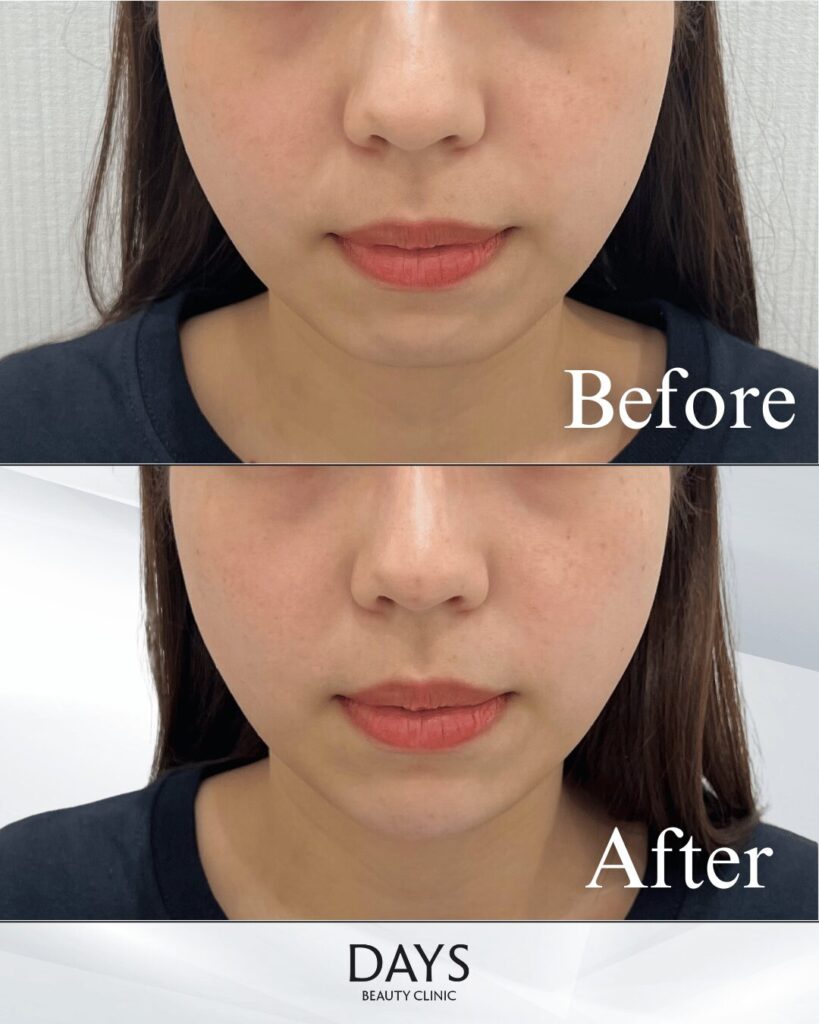 顎ヒアルロン酸　症例　20代女性