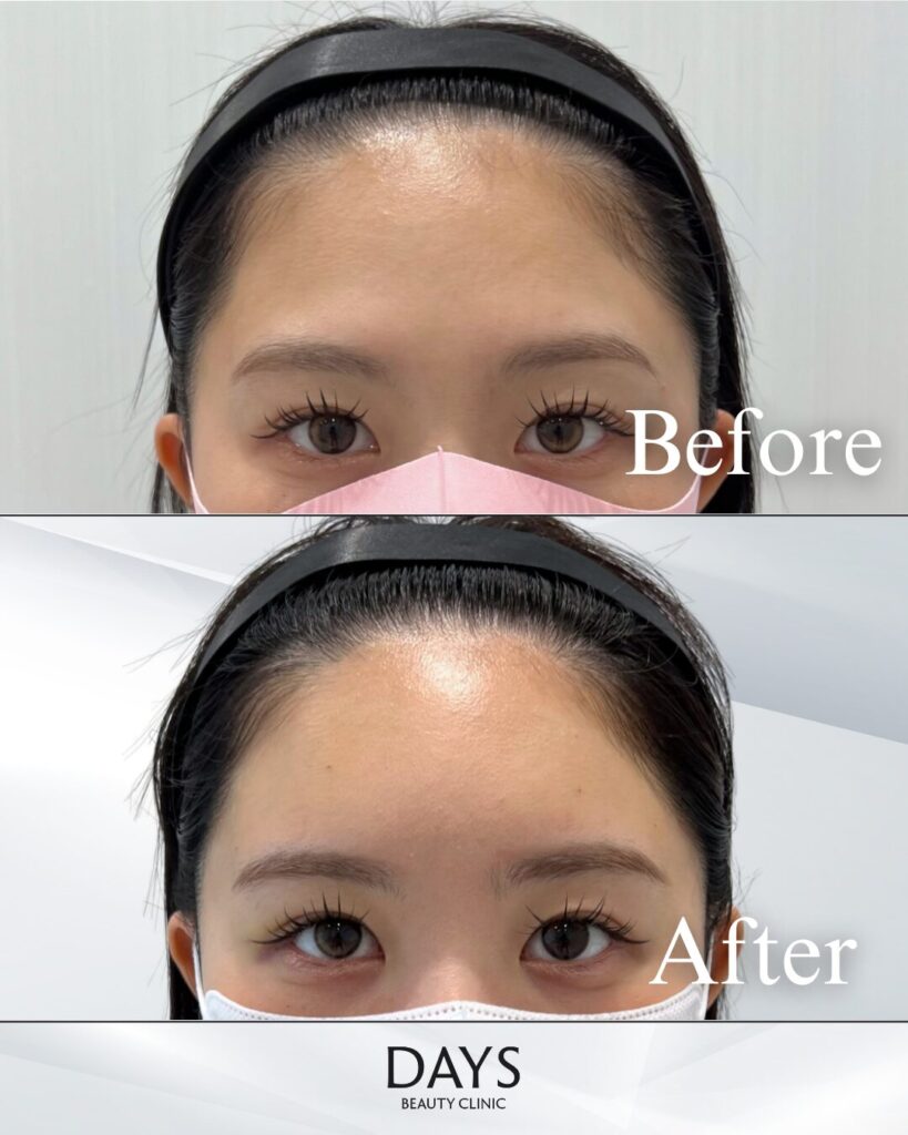 額のヒアルロン酸　症例　20代女性