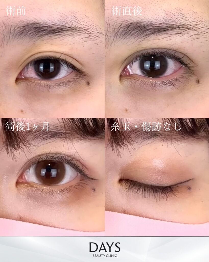 二重埋没　症例　20代女性