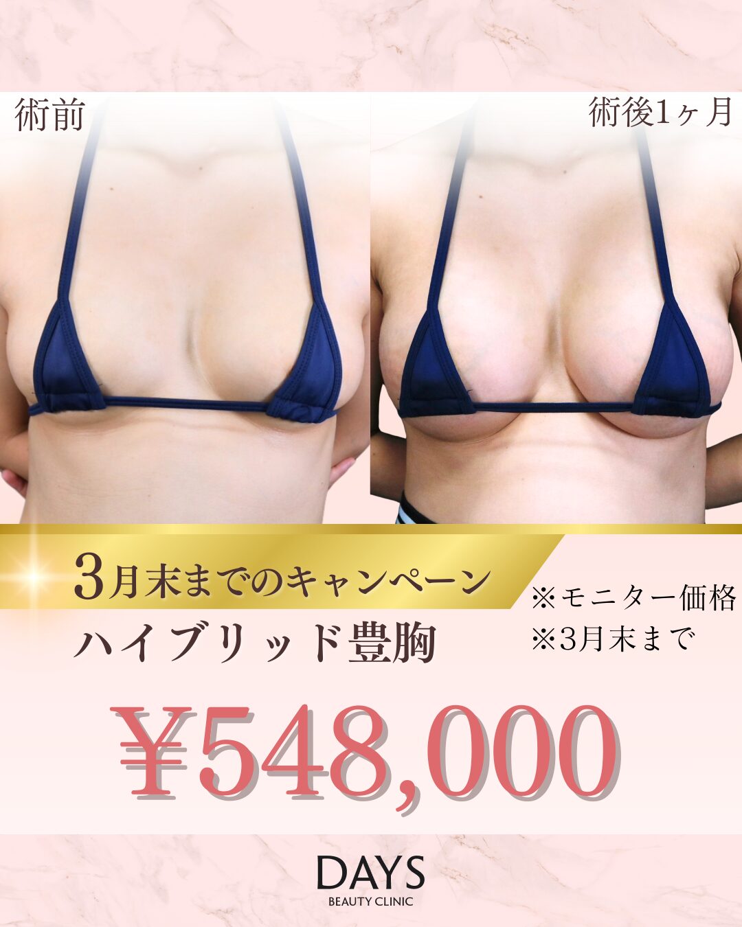 ハイブリット豊胸2603　