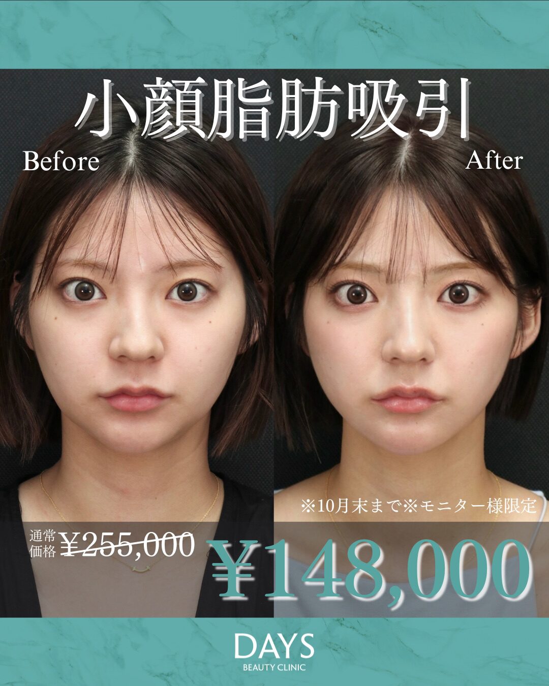 頬・顎下の脂肪吸引2510