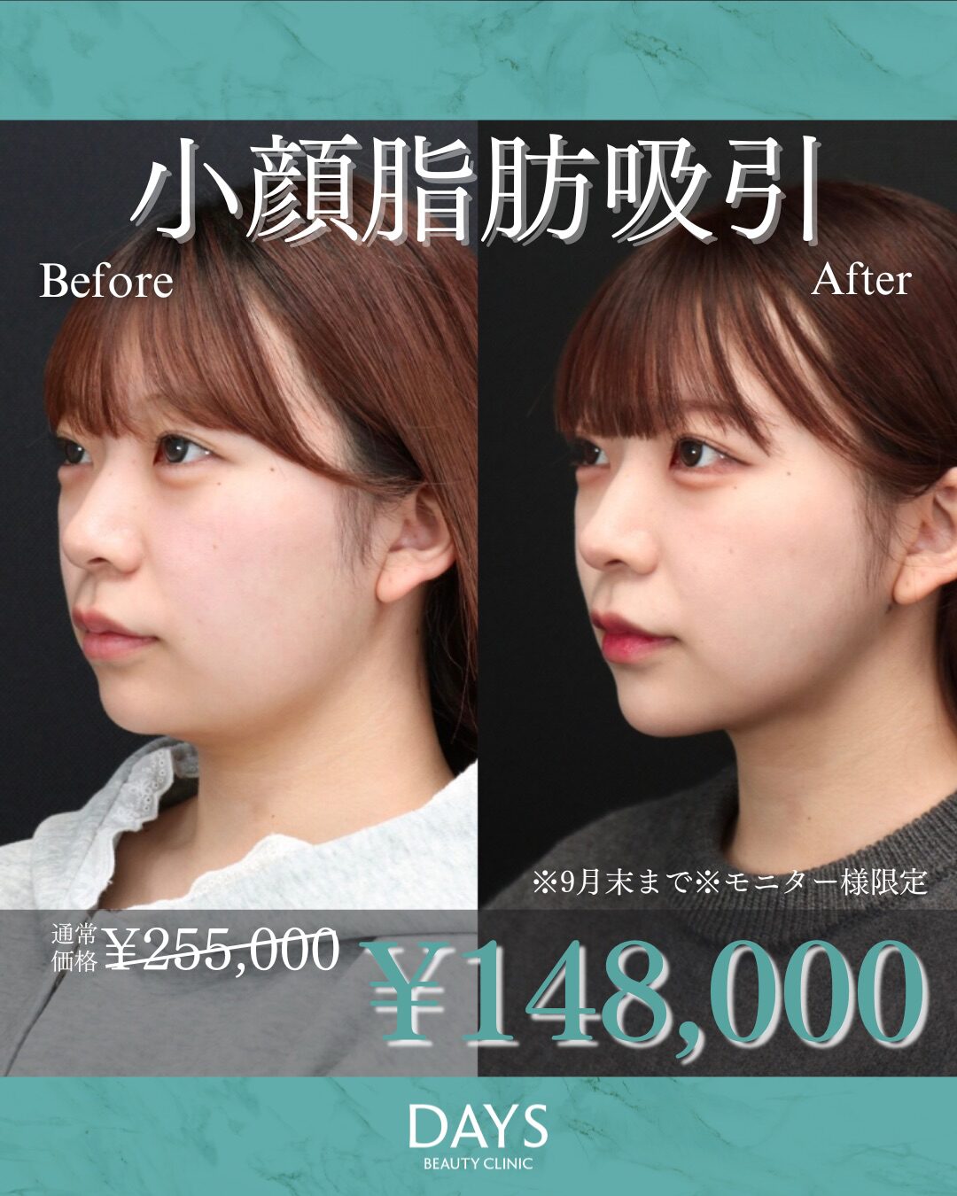 頬・顎下の脂肪吸引2509