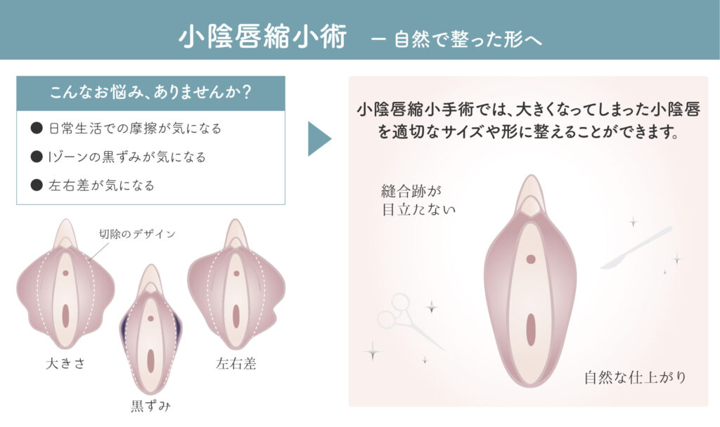 小陰唇縮小術