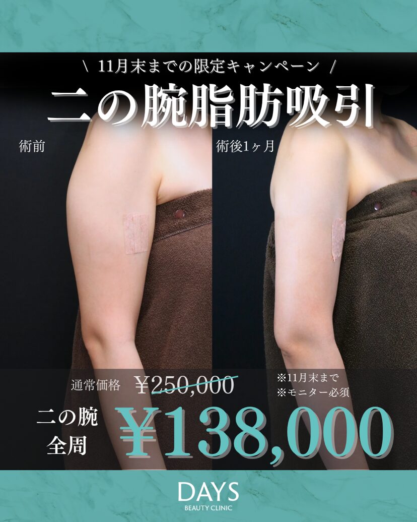 二の腕脂肪吸引2511