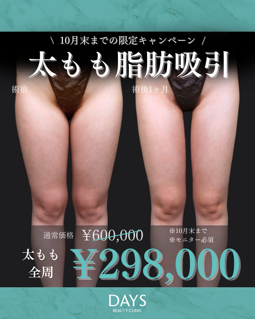 太もも脂肪吸引2510