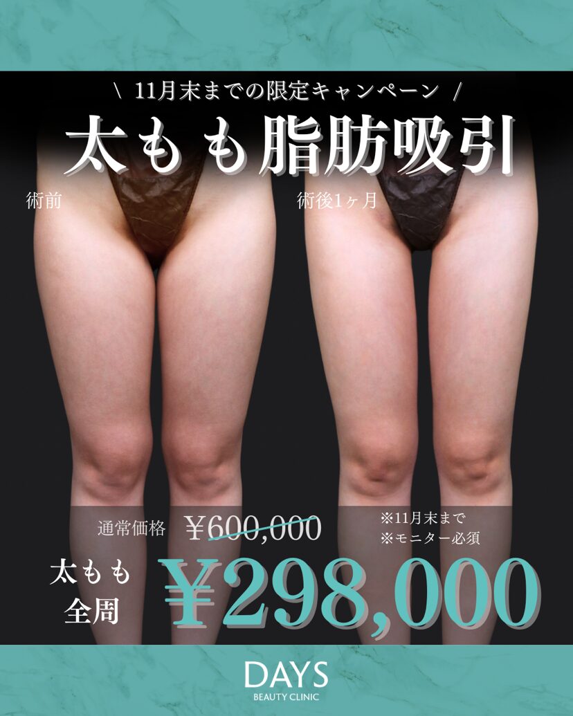 太もも脂肪吸引2511