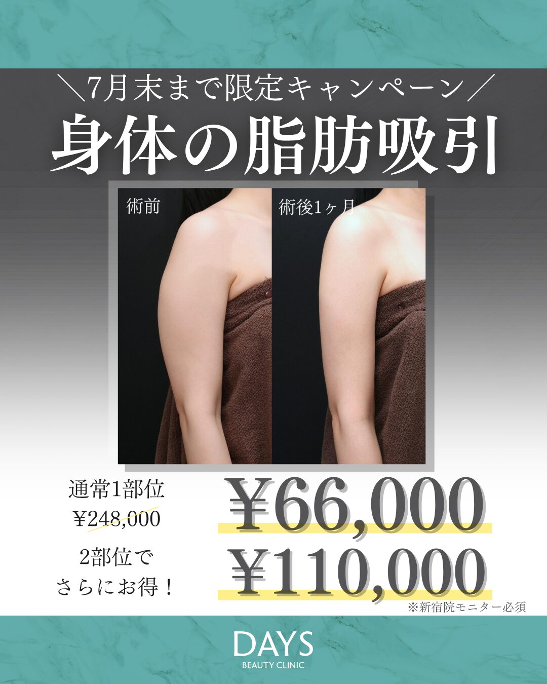 脂肪吸引01