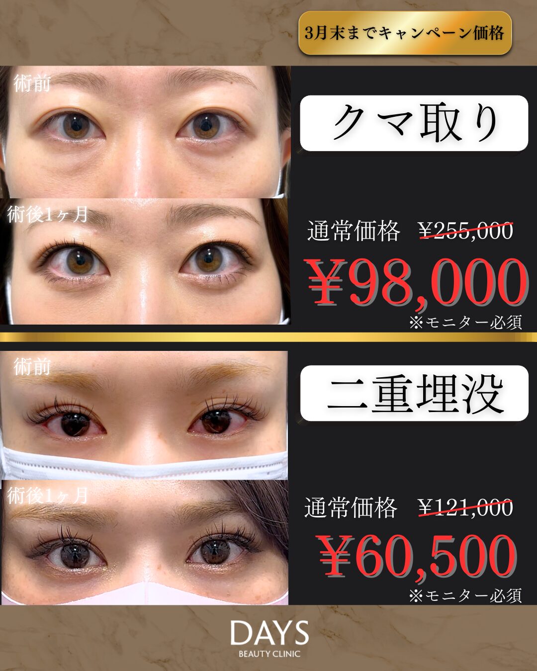 クマ取り・二重2603