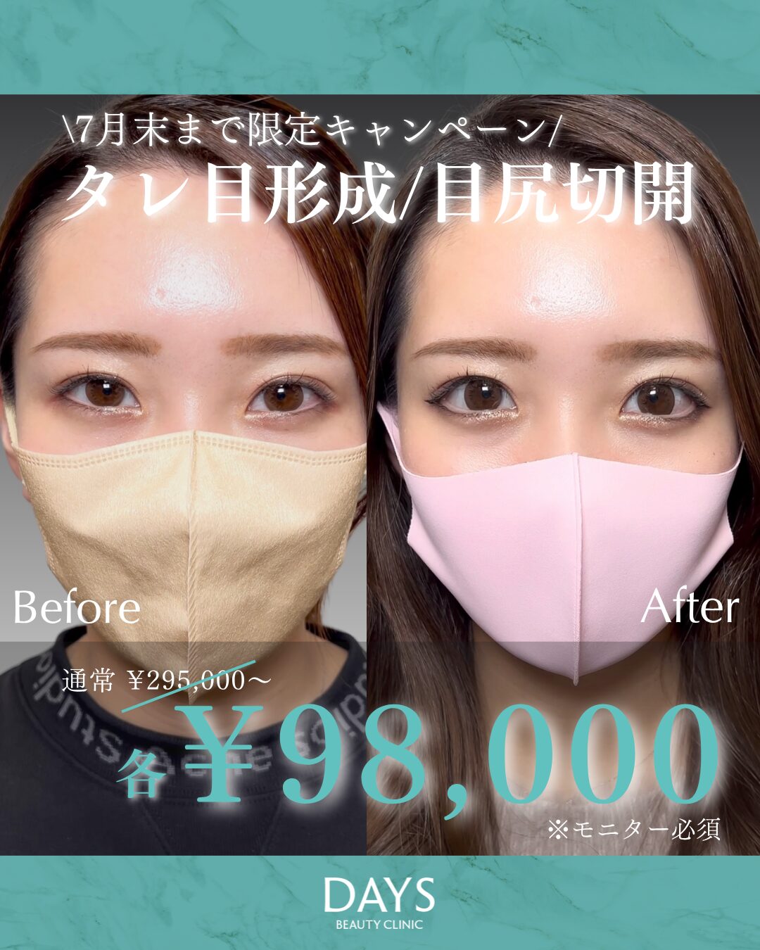 タレ目成形・目尻切開01
