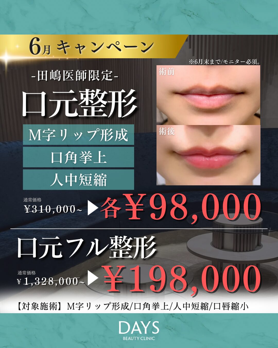M字・口角・人中・口唇縮小　田嶋　2606