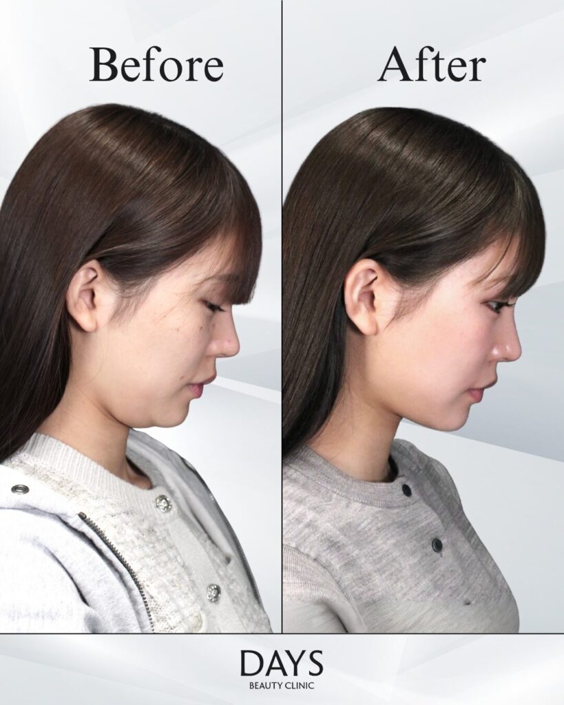 小顔　症例　20代女性