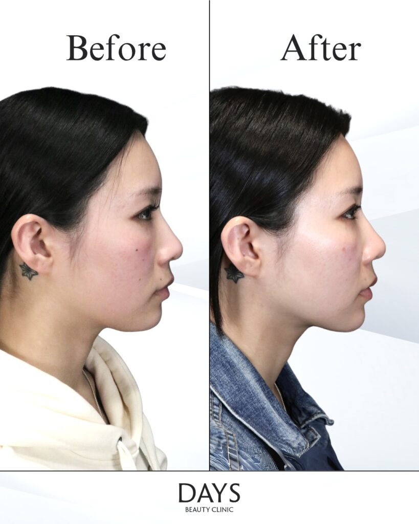 小顔　症例　20代女性