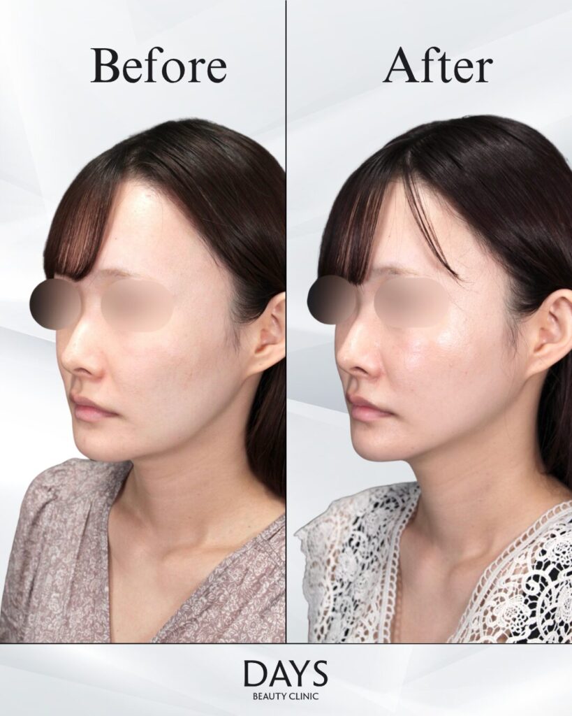 小顔　症例　20代女性