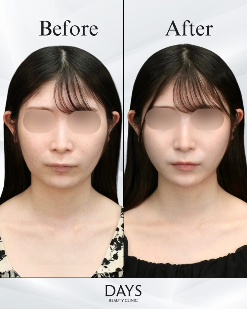 小顔　症例　20代女性