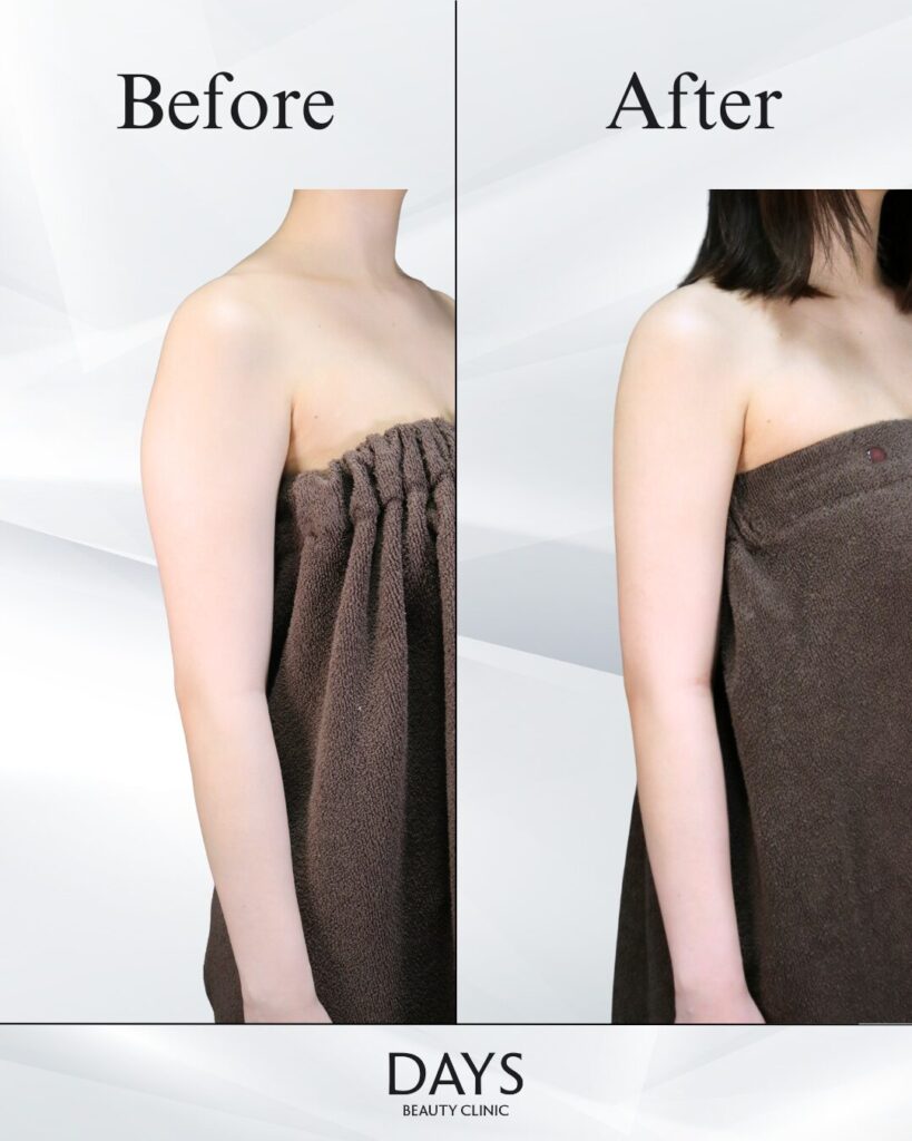 二の腕脂肪吸引　症例　20代女性