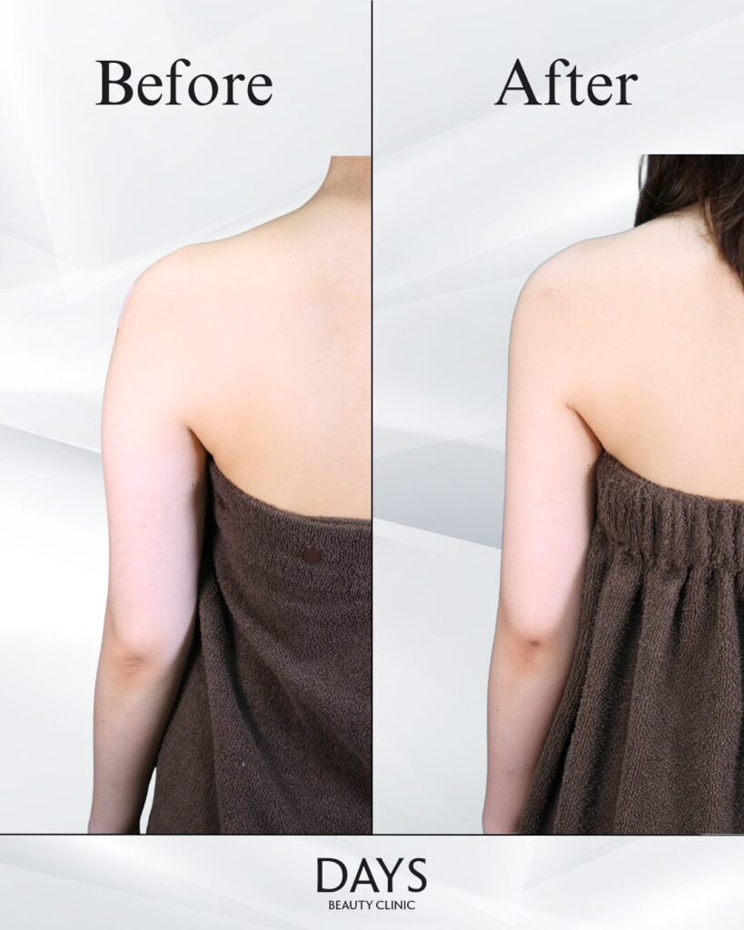 二の腕脂肪吸引　症例　20代女性