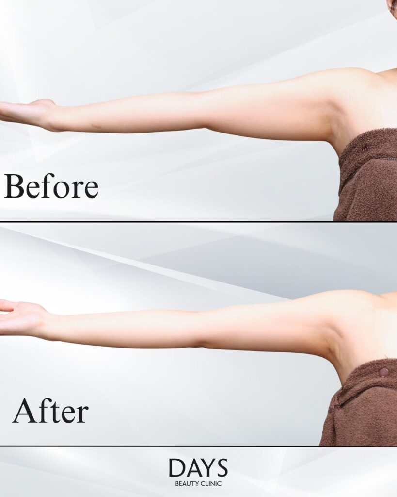 二の腕脂肪吸引　症例　20代女性