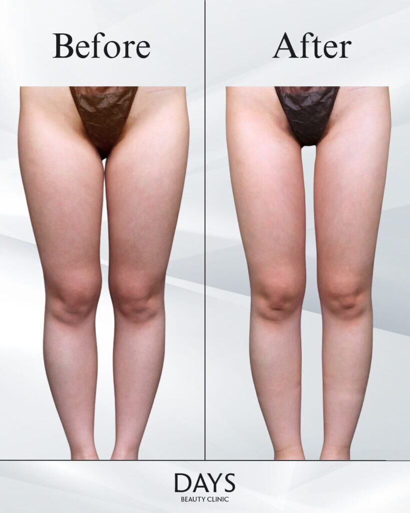 太もも脂肪吸引　症例　20代女性