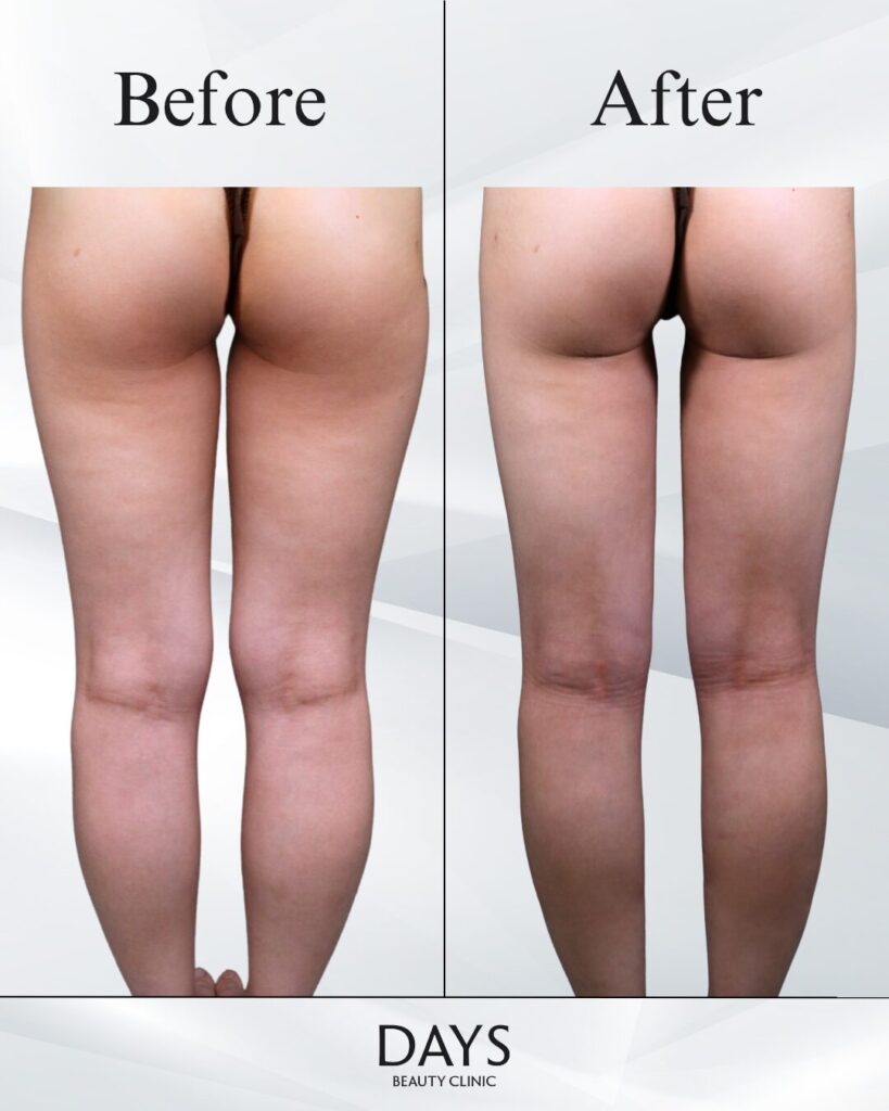 太もも脂肪吸引　症例　20代女性