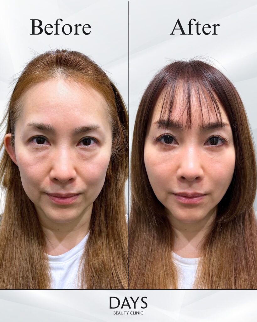 クマ取り　症例　40代女性