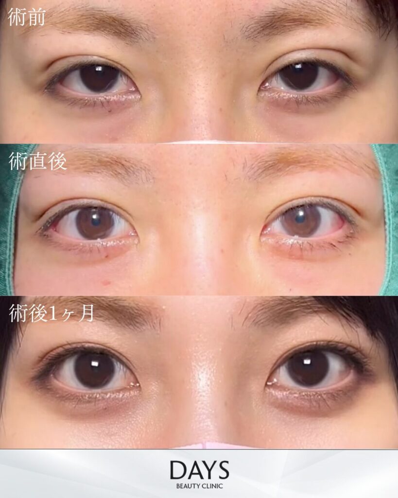 二重埋没　症例　30代女性