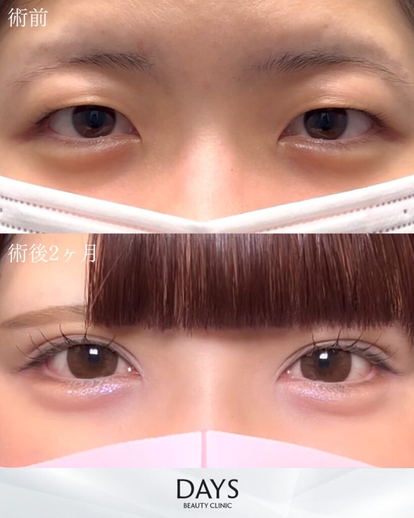 二重埋没　症例　２０代女性