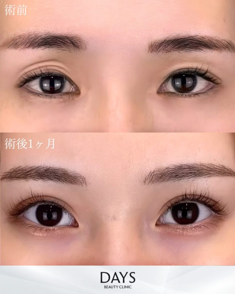 二重埋没　症例　20代女性