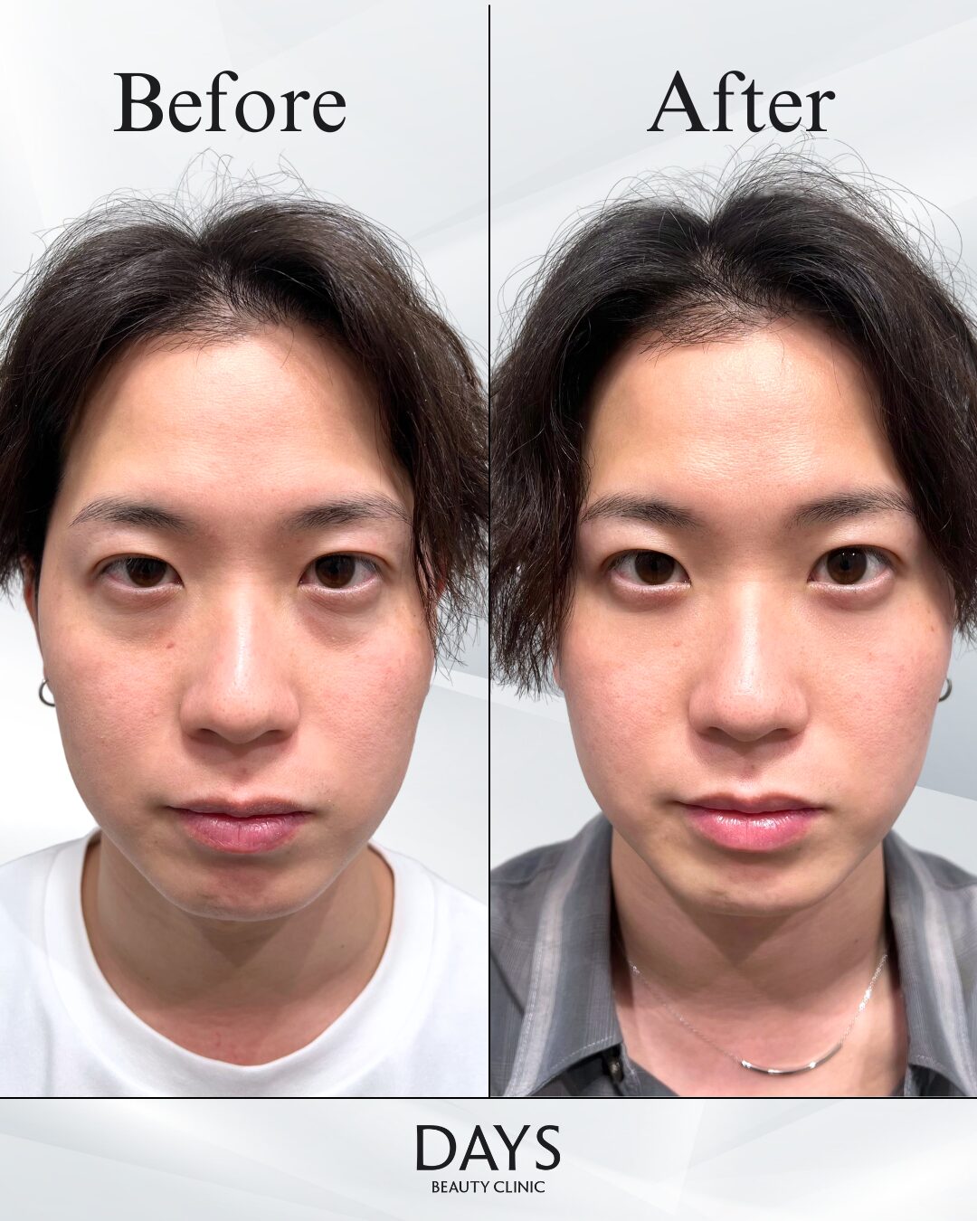 クマ取り　症例　20代男性