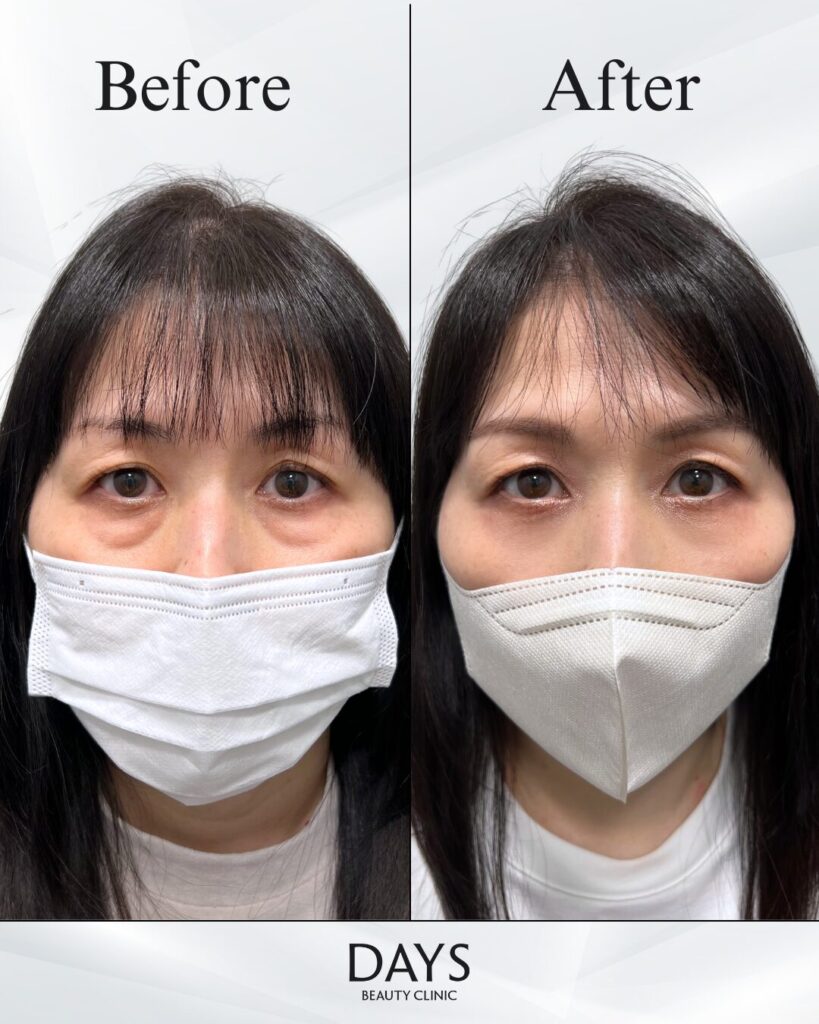 裏ハムラ　症例　40代女性