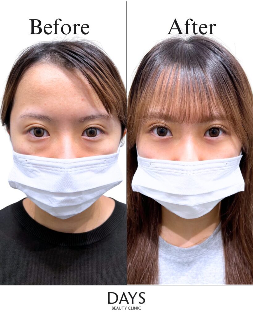 クマ取り　症例　30代女性