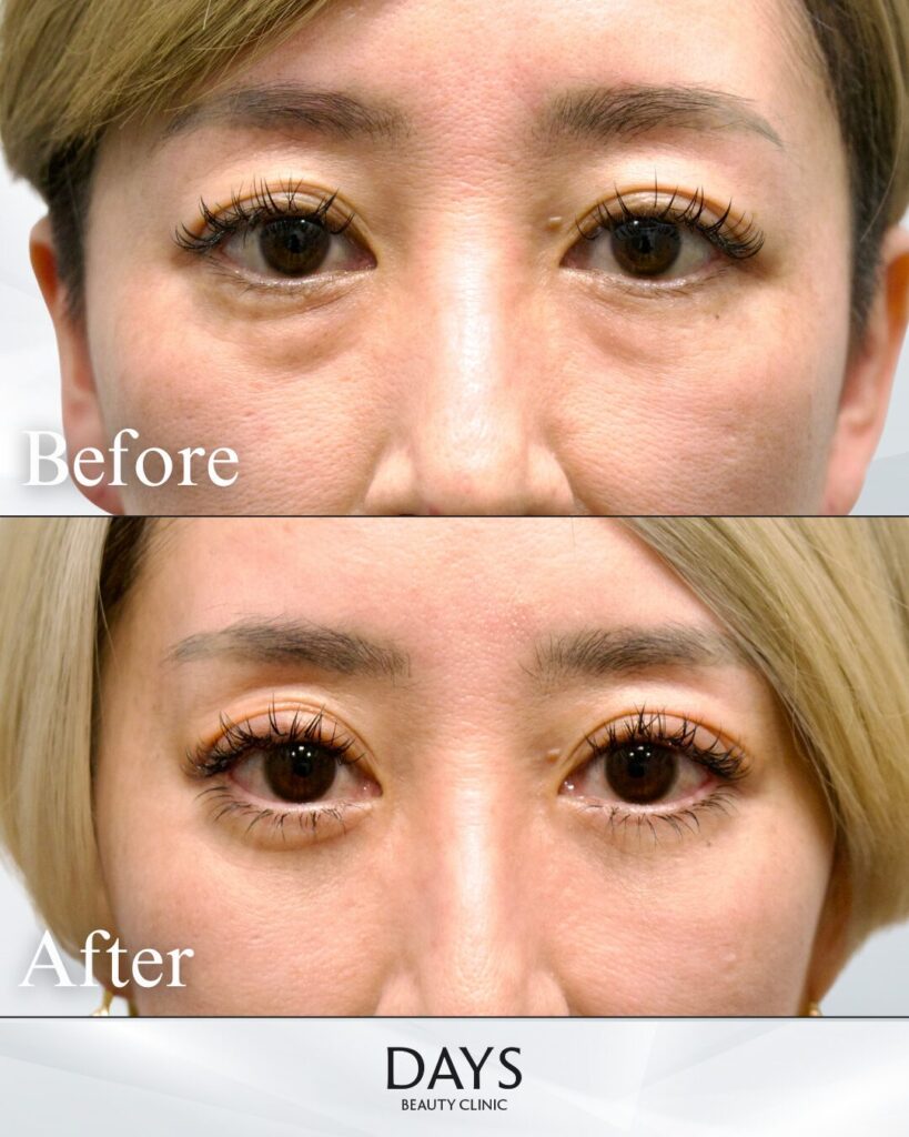 裏ハムラ　症例　40代女性