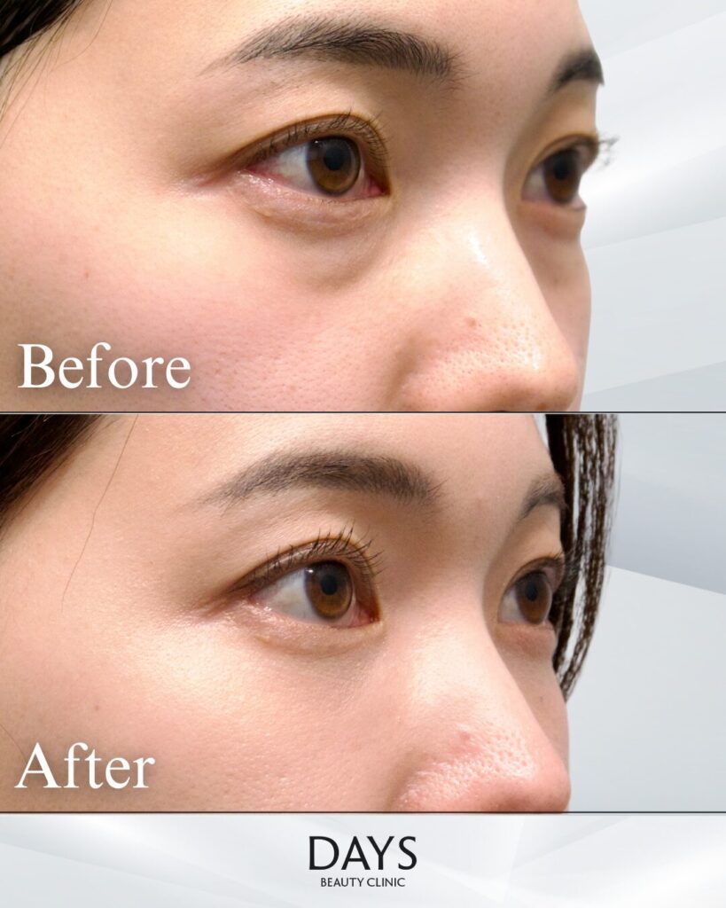 裏ハムラ　症例　30代女性