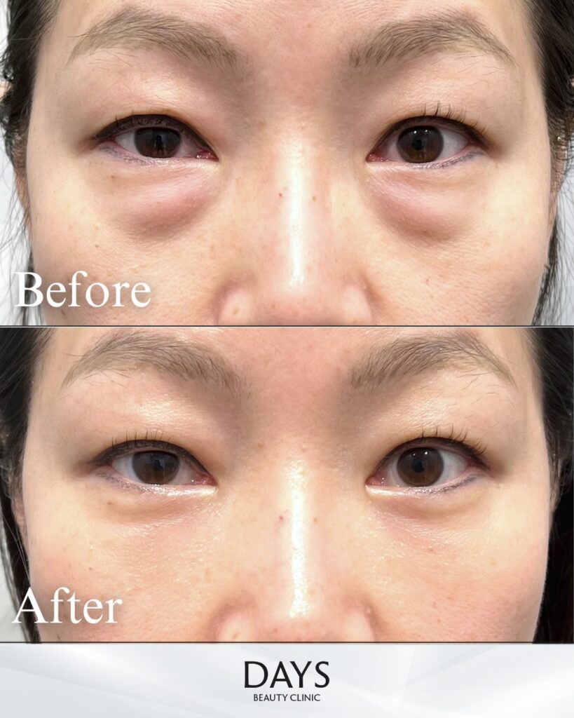 クマ取り　症例　40代女性