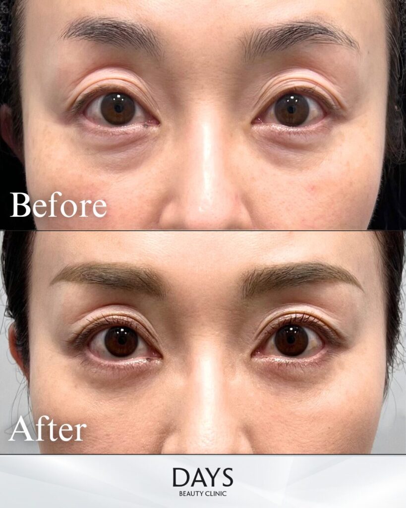 裏ハムラ　症例　50代女性