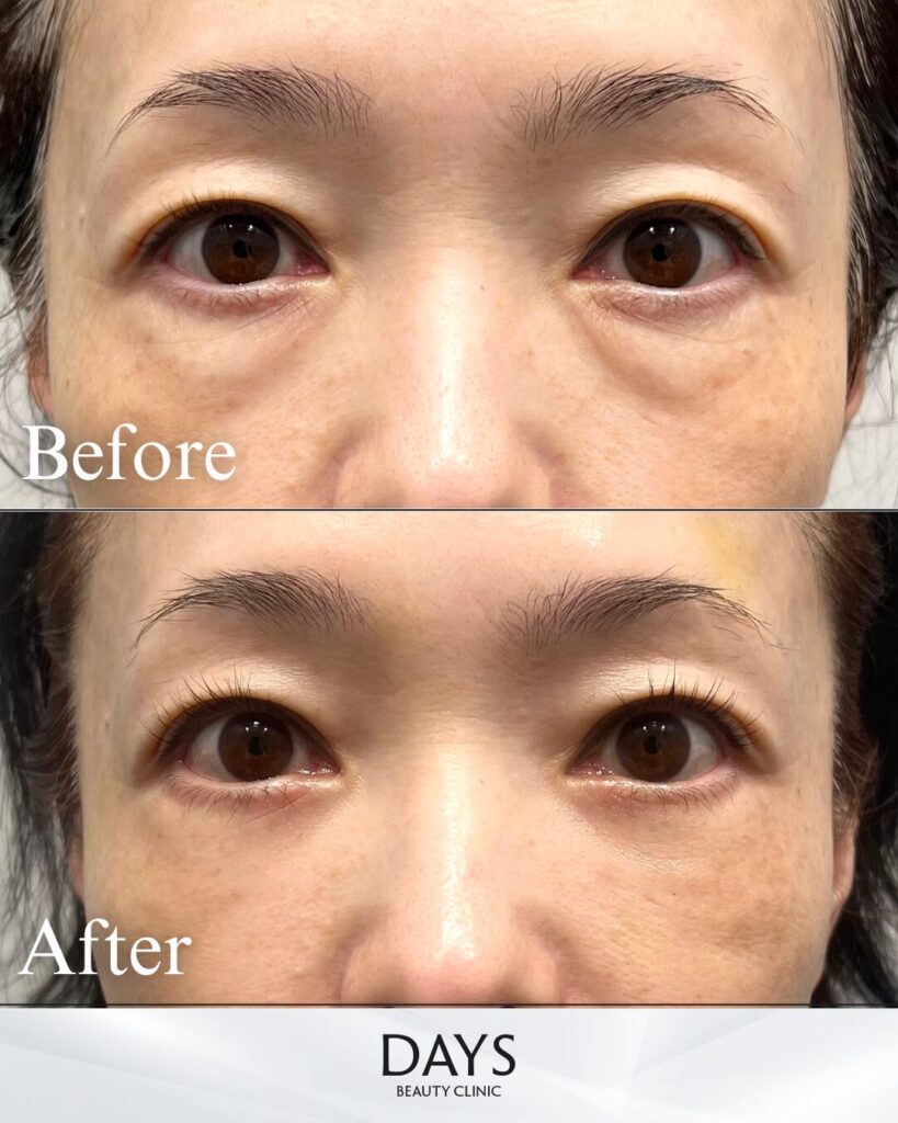 裏ハムラ　症例　40代女性