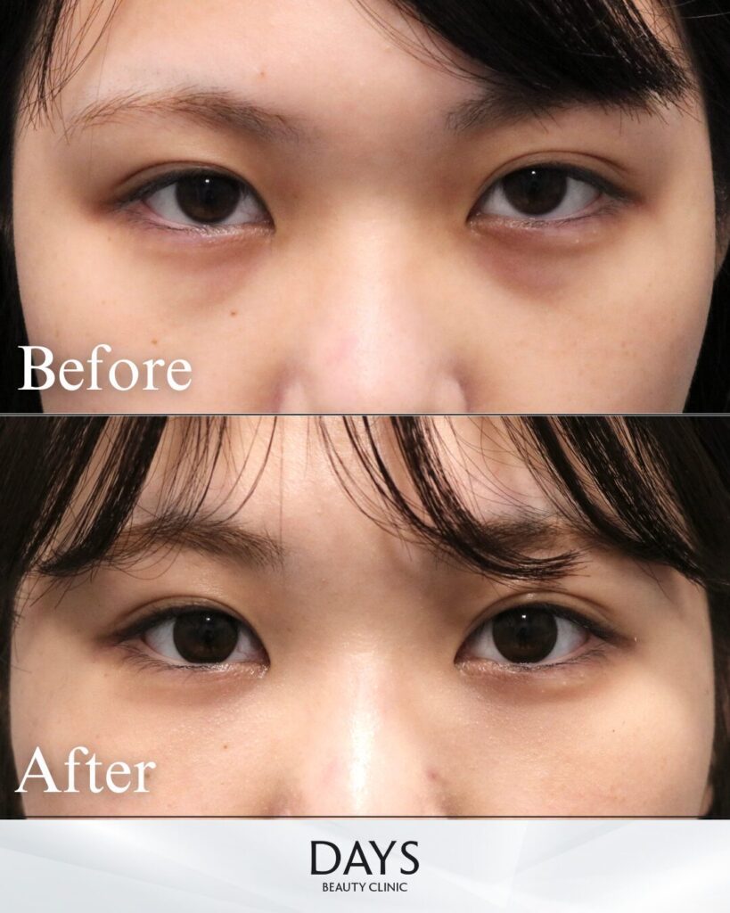 裏ハムラ　症例　20代女性