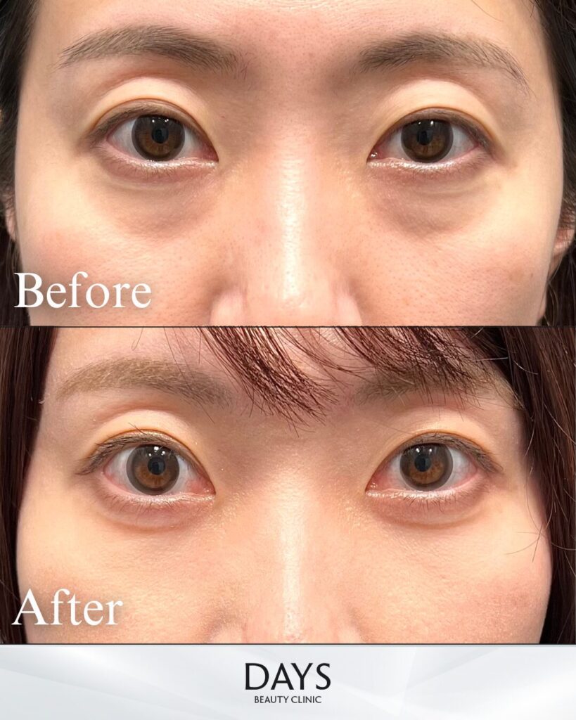 クマ取り　症例　４０代女性