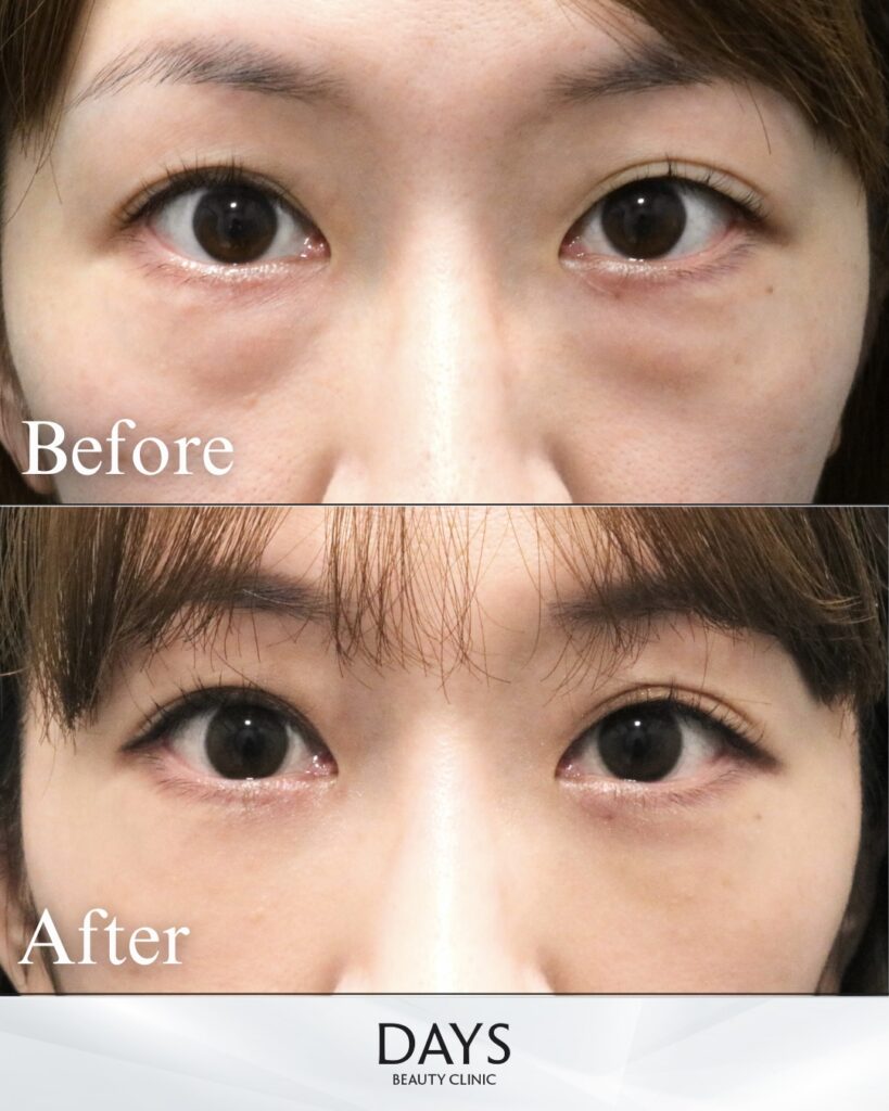 クマ取り　症例　40代女性