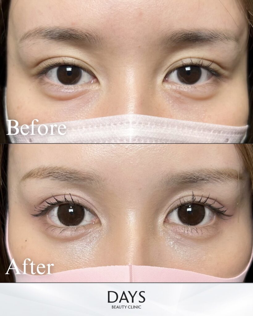 タレ目形成　症例　20代女性