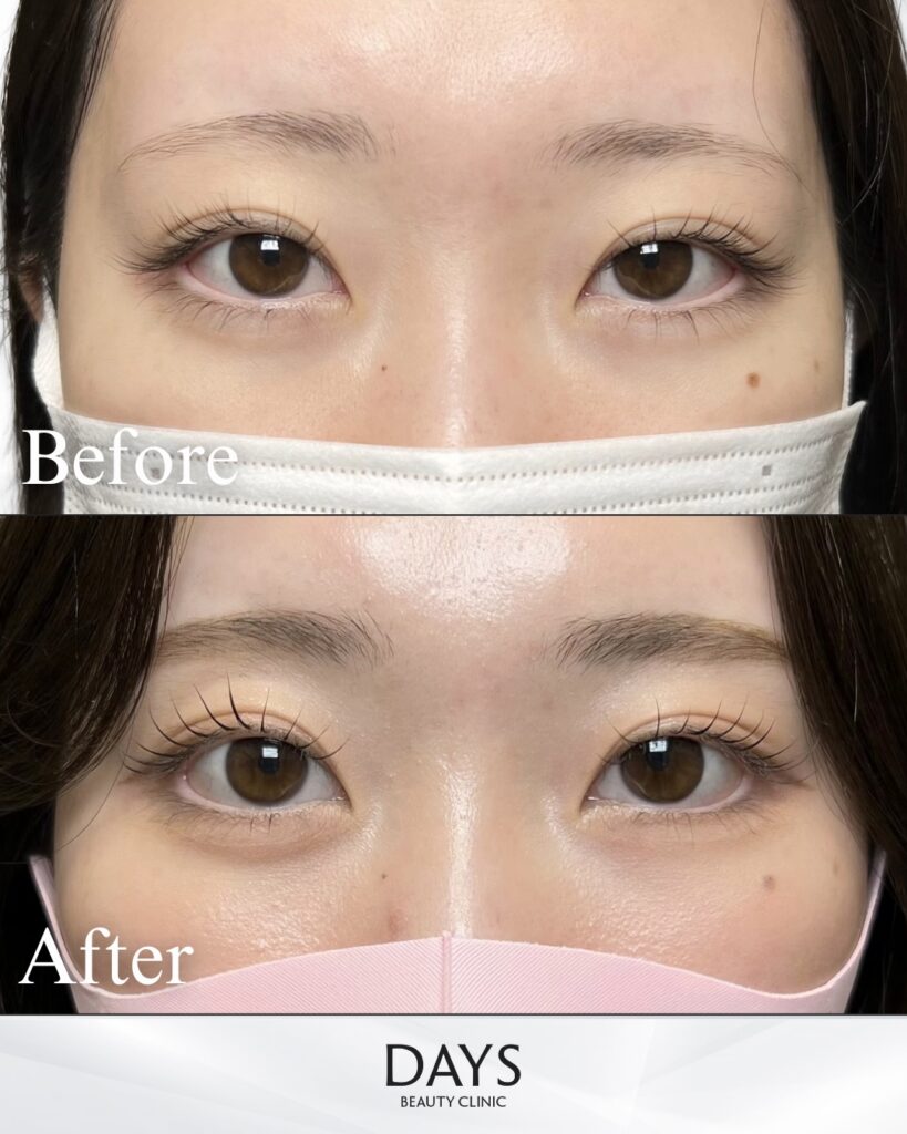 タレ目形成　症例　20代女性