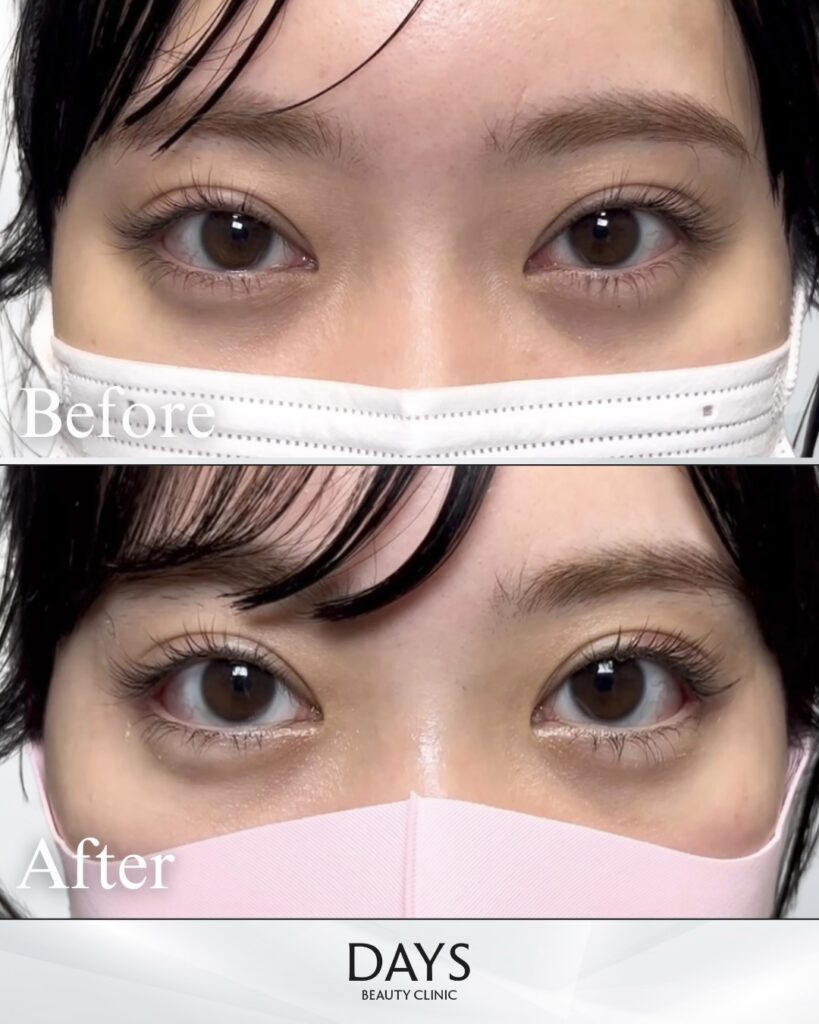 タレ目形成　症例　２０代女性