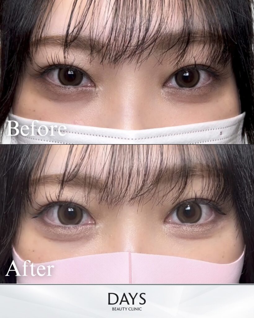 タレ目形成　症例　20代女性