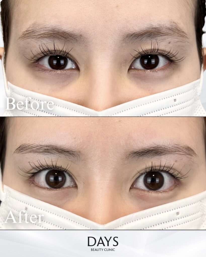 グラマラスライン形成　症例　20代女性