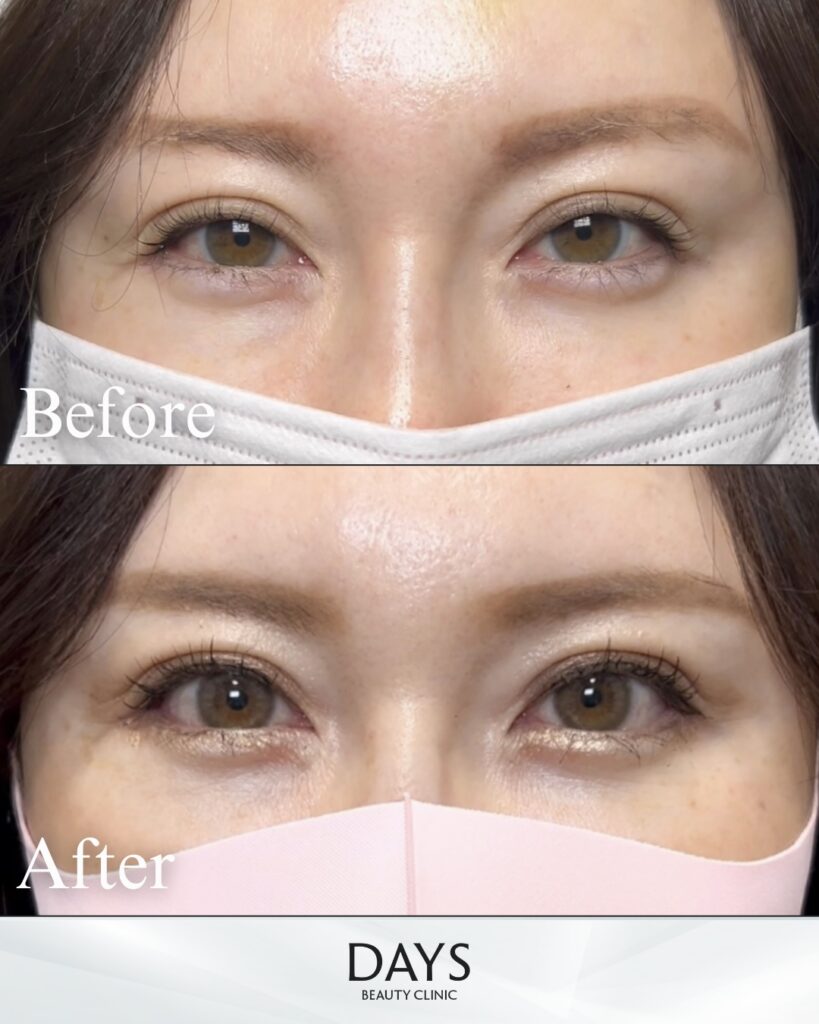 グラマラスライン形成　症例　50代女性