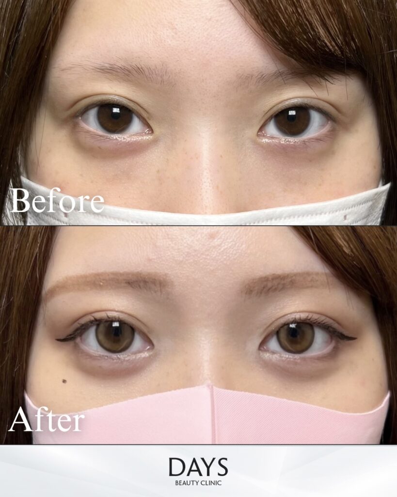 グラマラスライン形成　症例　20代女性